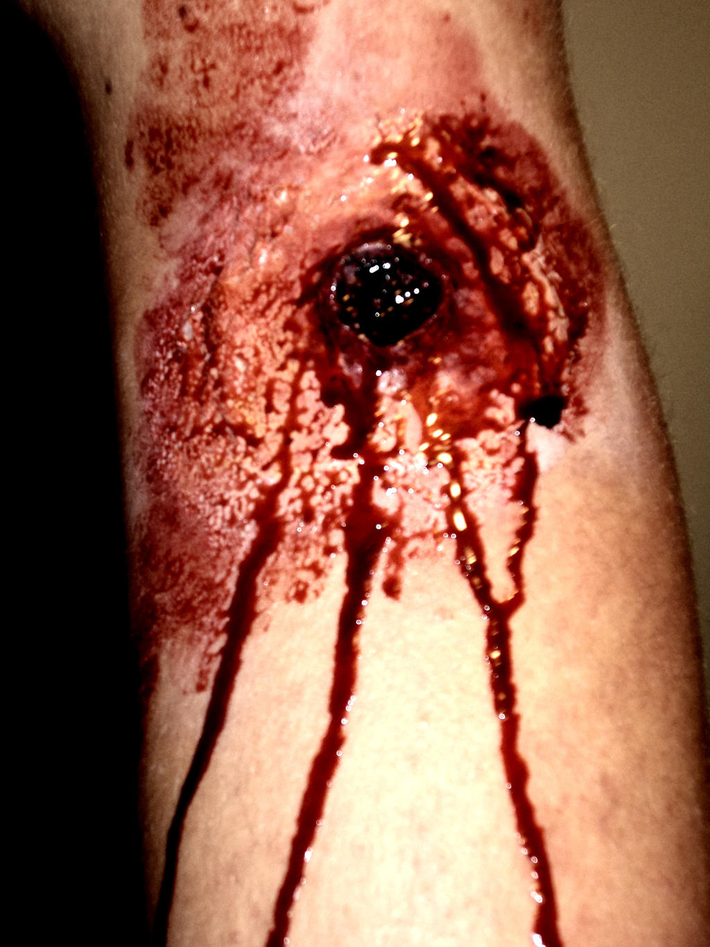 leg wound #11